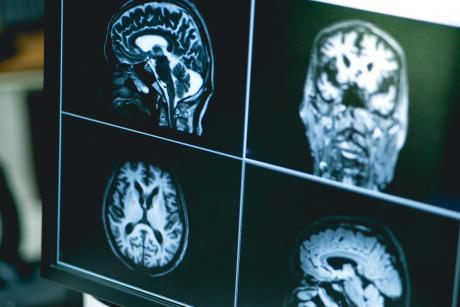 Scan of dementia in brain