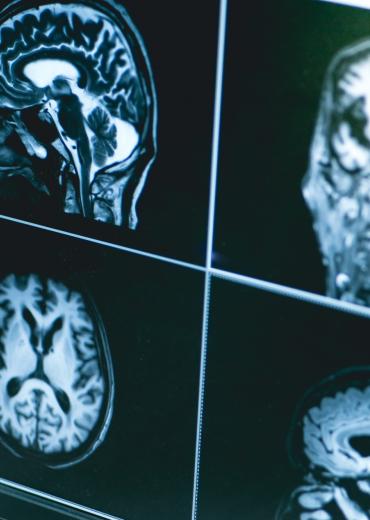 Scan of dementia in brain